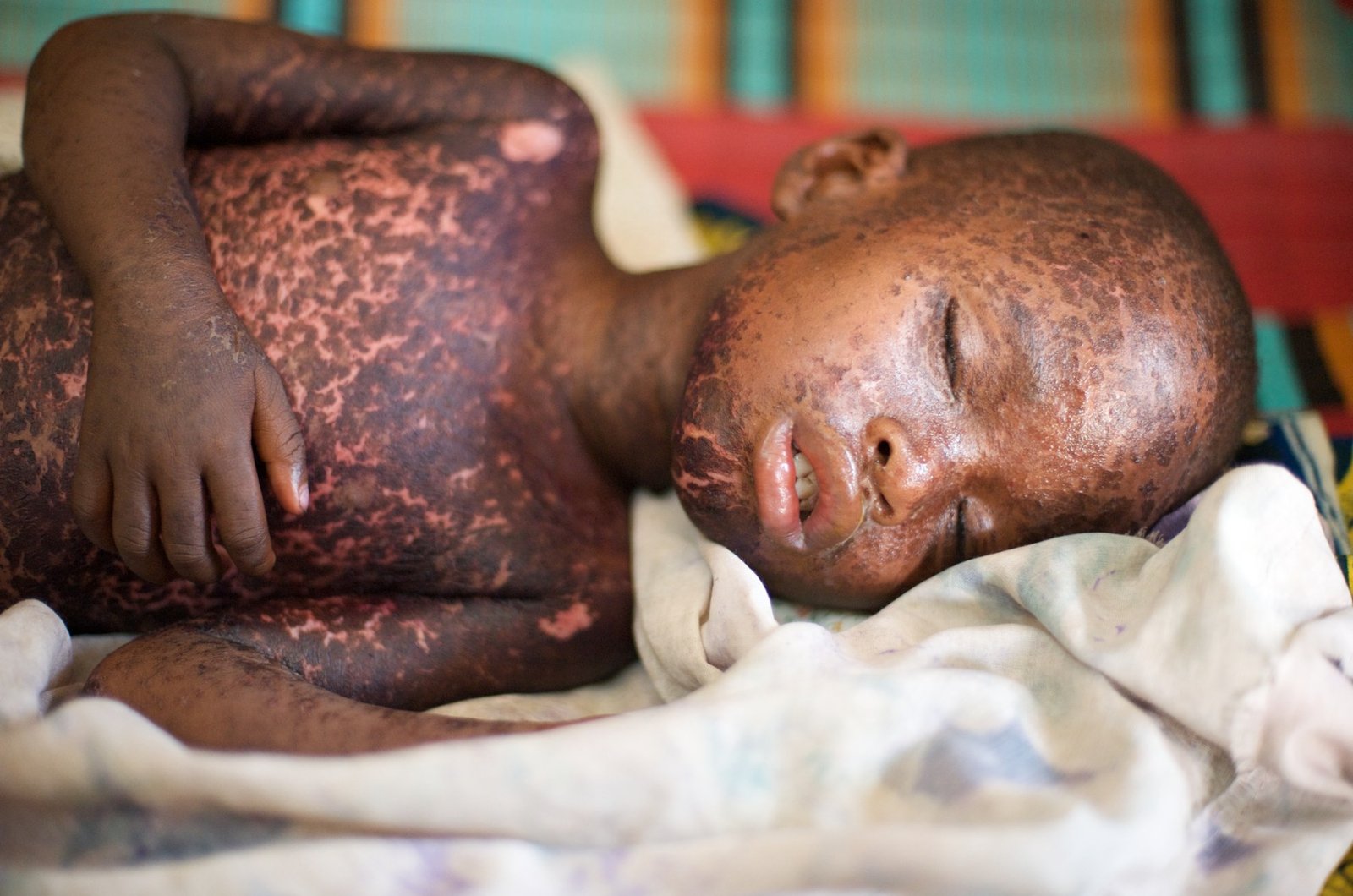 A child with a measles rash, photographed during a measles epidemic in Guinea in 2009 (file photo).